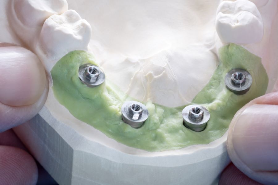 What is an Abutment, What Does It Do?