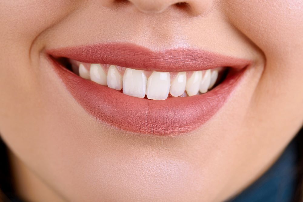 What is the Hollywood Smile?